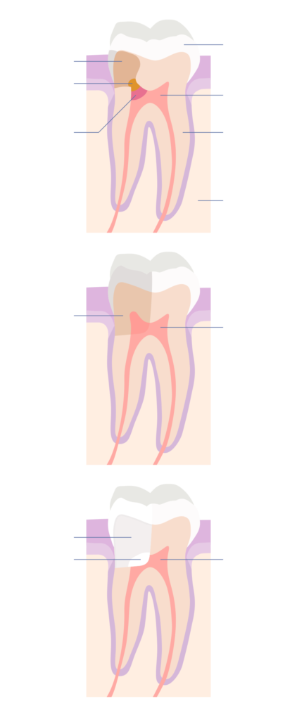 Repairing a tooth using vital pulp therapy diagram