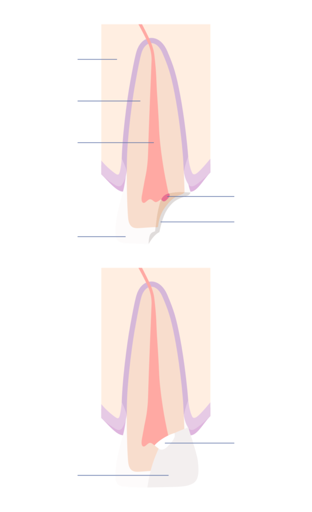 Repairing a tooth with vital pulp therapy